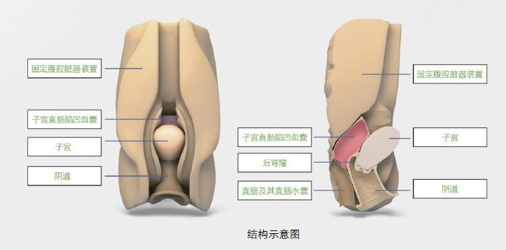 陰道后穹窿穿刺監(jiān)測(cè)考核指導(dǎo)模型,模具 陰道后穹窿穿刺監(jiān)測(cè)考核指導(dǎo)模型,模具